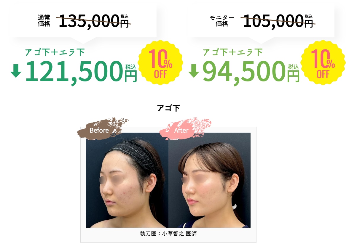 脂肪吸引注射10%OFFキャンペーンの症例【湘南美容クリニックいわき院】