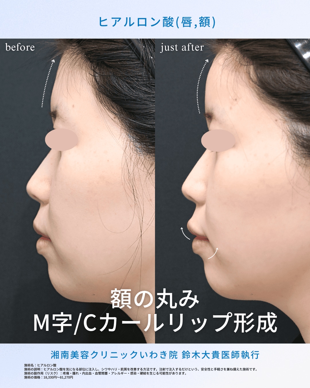 ミリ単位の繊細なデザインと精密な注入