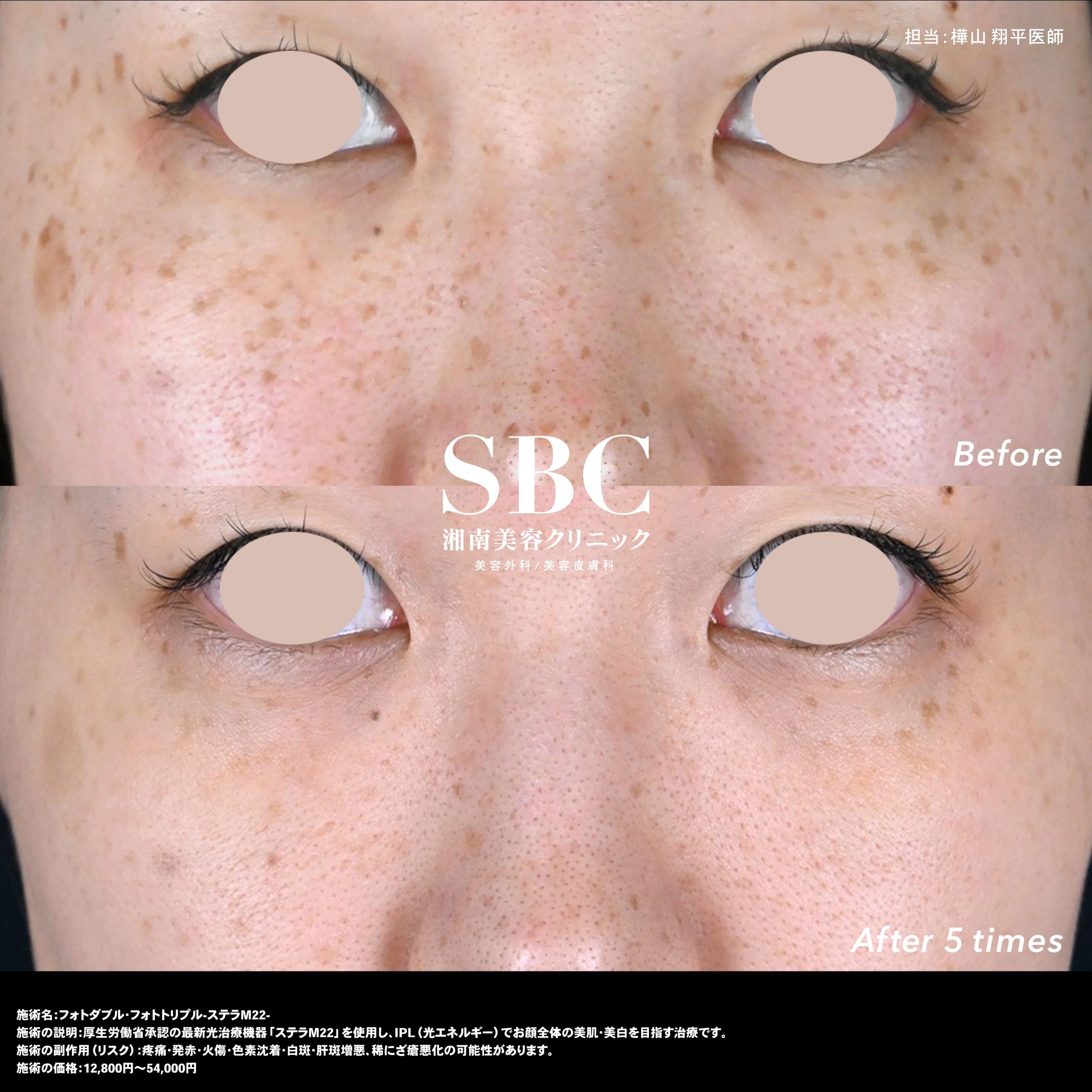 IPL光治療(フォトダブル®,フォトトリプル)症例