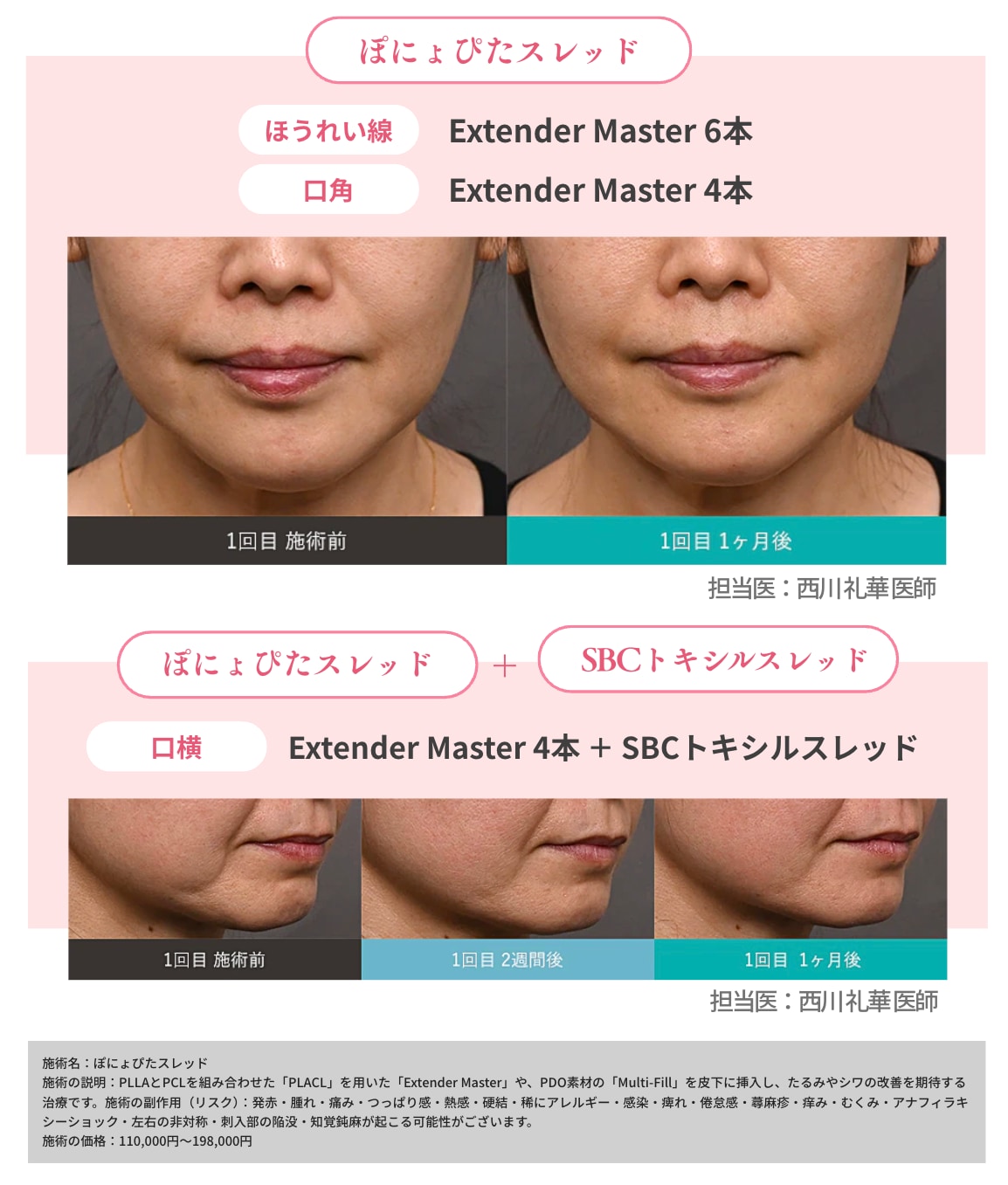 ぽにょぴたスレッド症例写真