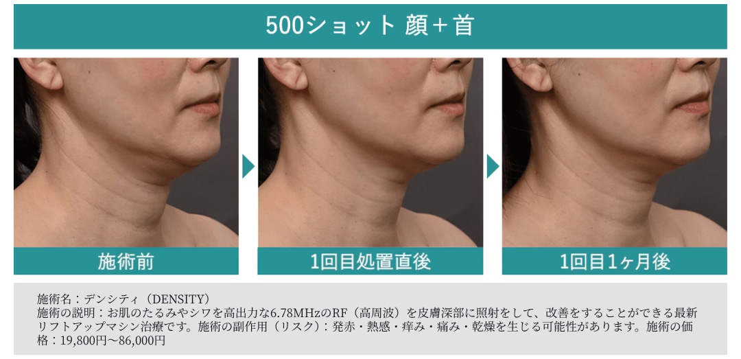 500ショット 顔＋首
