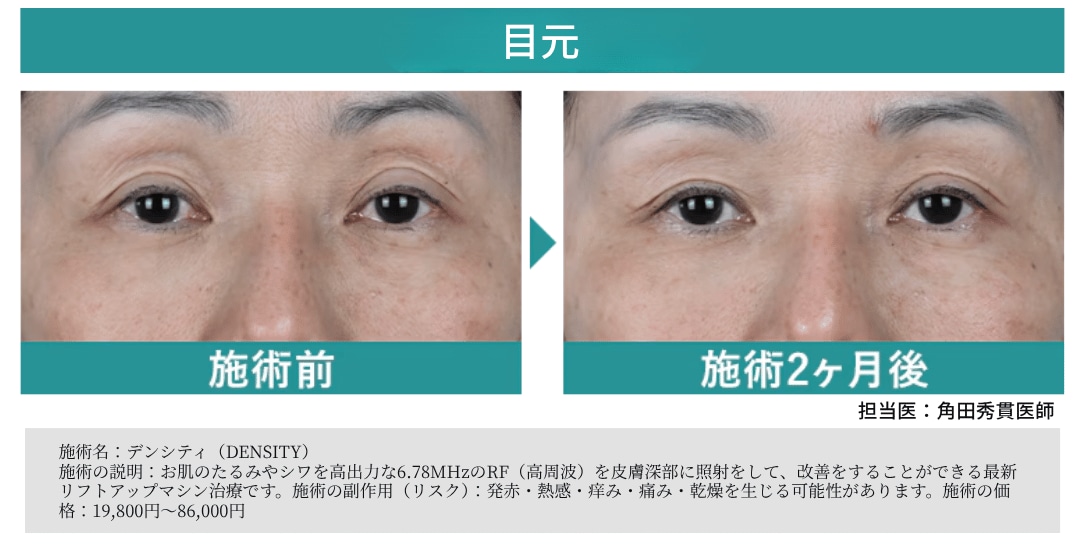 👁️実はまぶたにも照射できるDENSITY(デンシティ)👁️