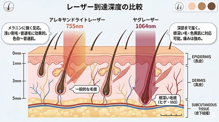 アレキサンドライトレーザーとYAGレーザーの特性