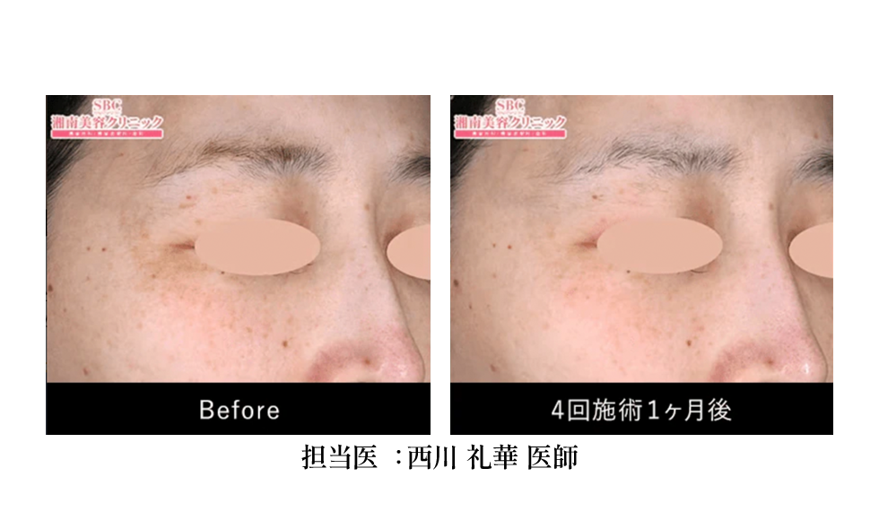 症状：肝斑、くすみ