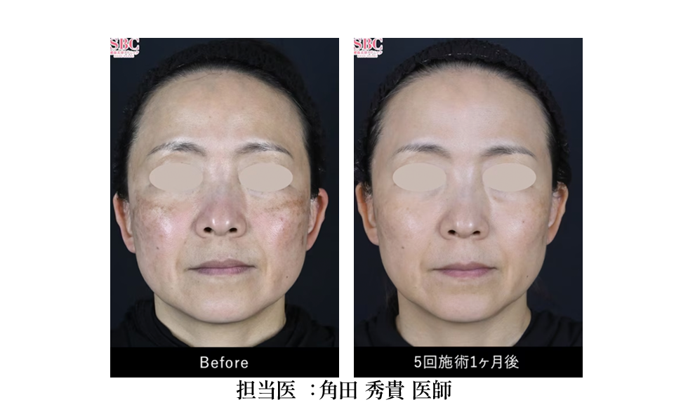 症状：色素沈着・赤み・毛穴改善