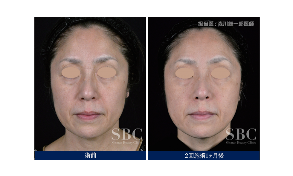 プロファイロの効果