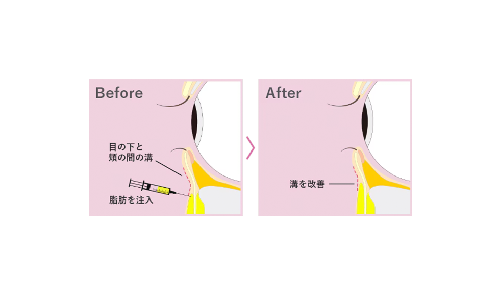 目の下の切らないクマ取り＋脂肪注入