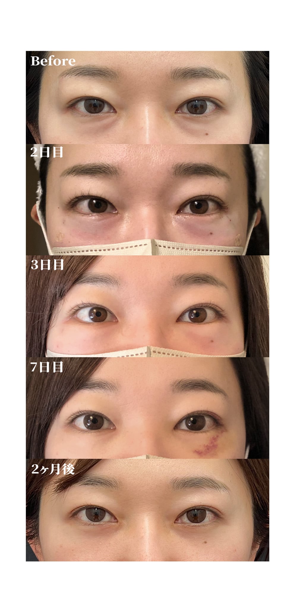 目の下の切らないクマ・たるみ取り＋脂肪注入