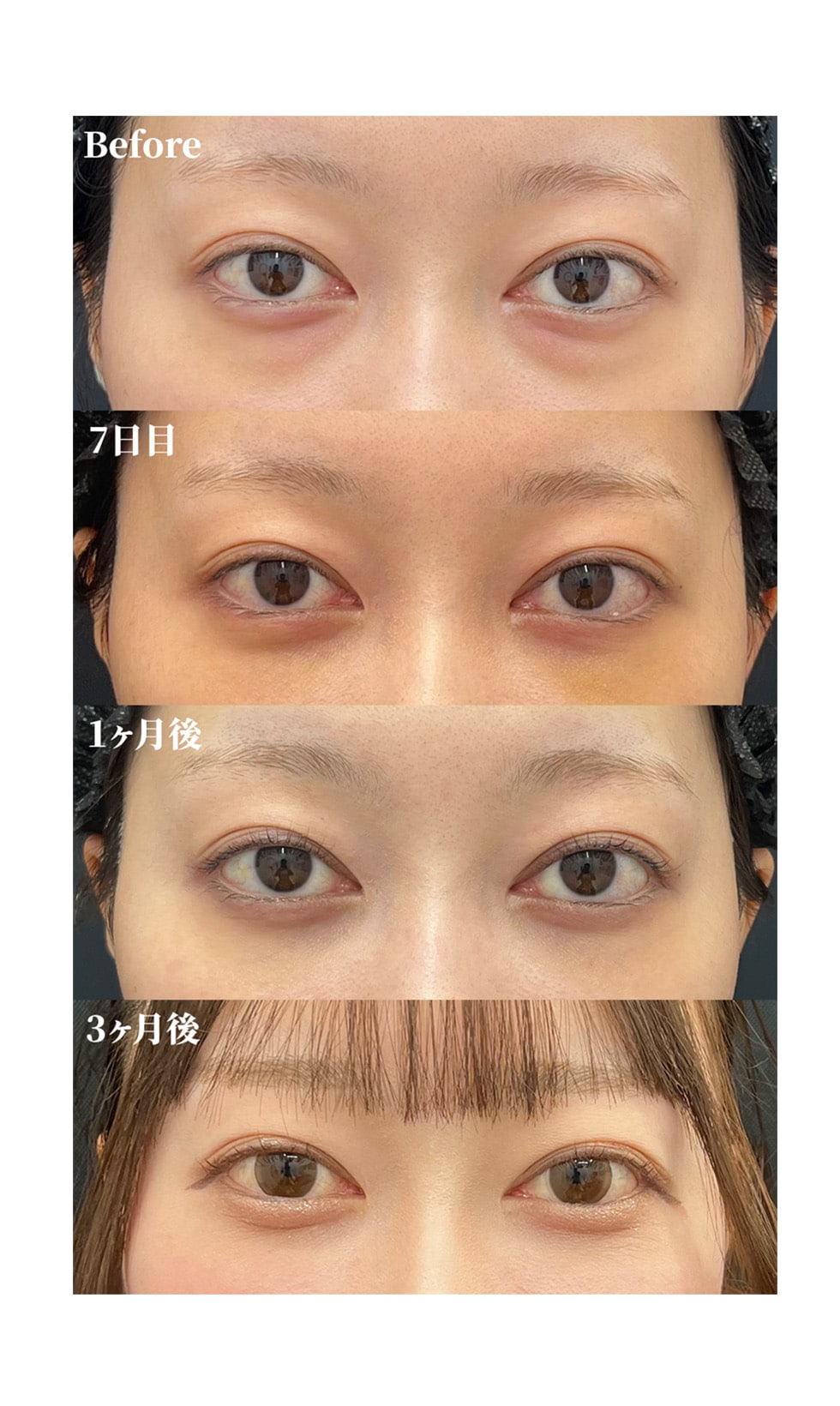 裏ハムラの症例