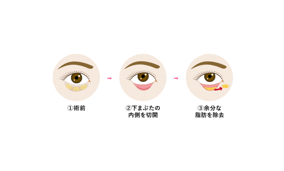 目の下の切らないクマ・たるみ取り