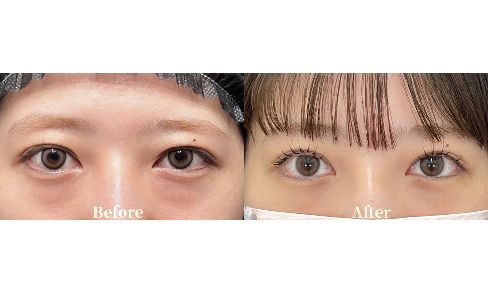 目の下の切らないクマ・たるみ取り症例