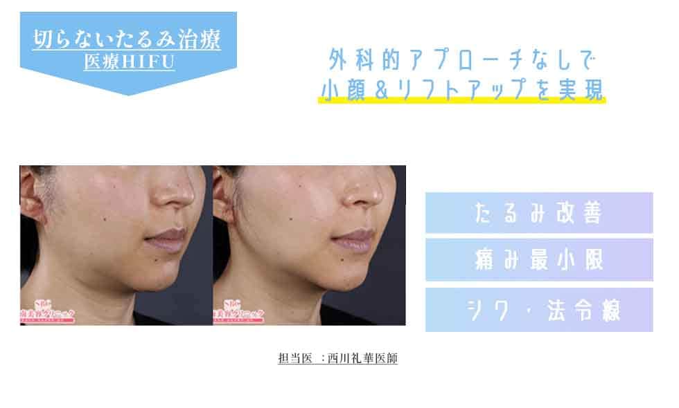 ウルトラリフトプラスHIFU