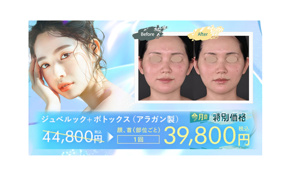 ジュベルック水光注射＋ボトックス(アラガン製)
