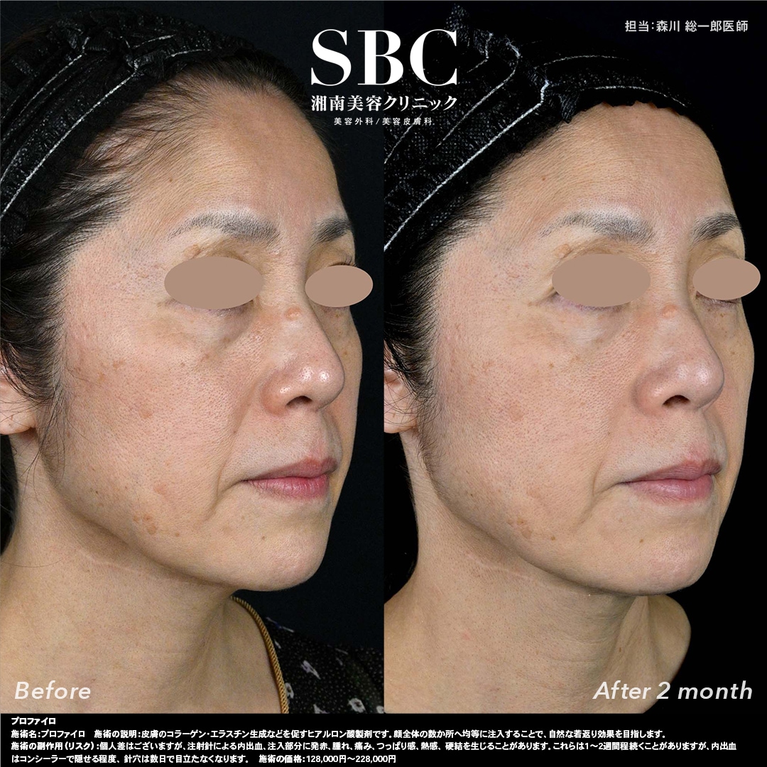 30代後半から気になる小じわ・たるみへの効果<br />
