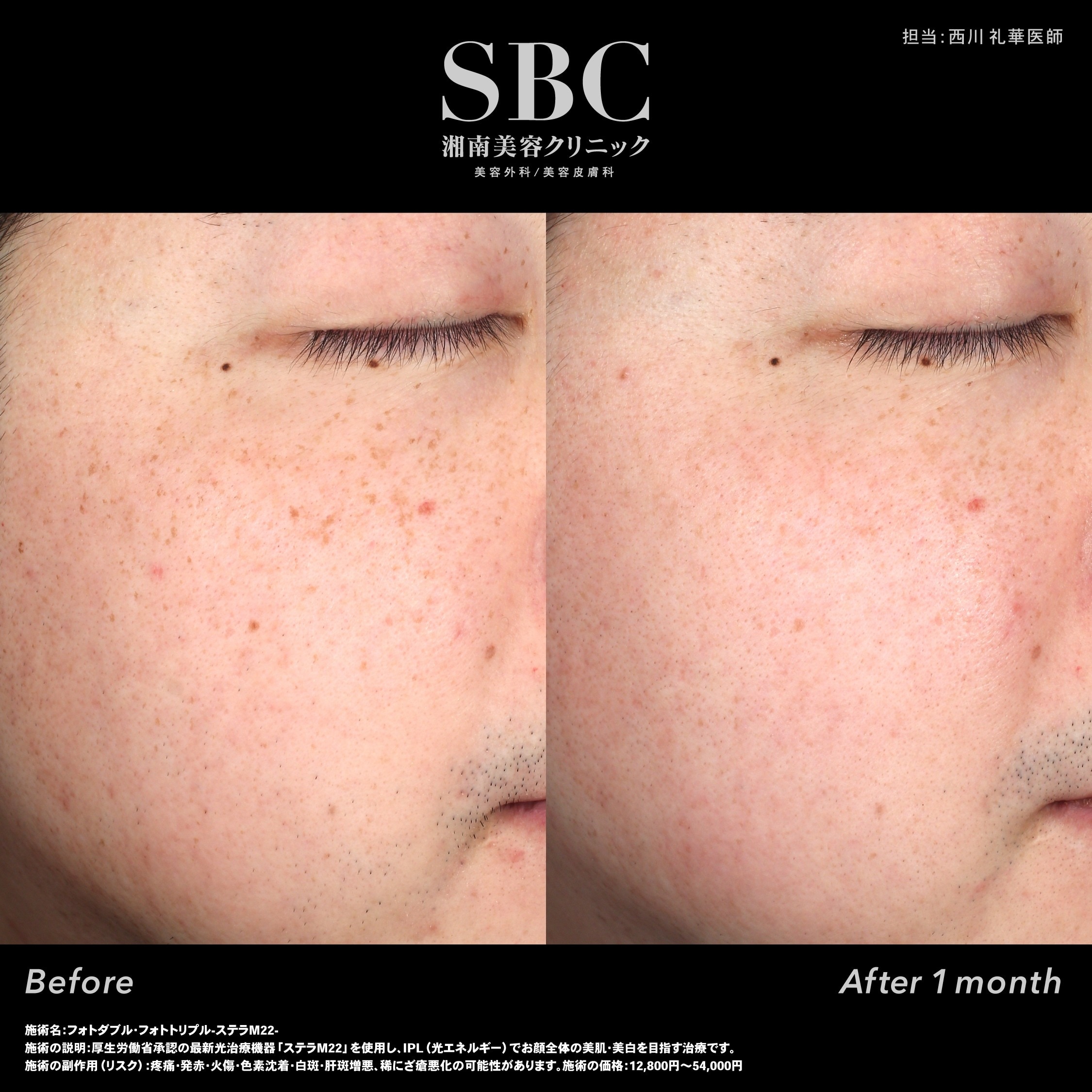 フォトフェイシャル（IPL光治療）｜全体のくすみ・そばかすに