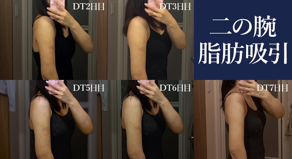 術後3日間は圧迫固定着、その後の1週間はボレロの着用が必須