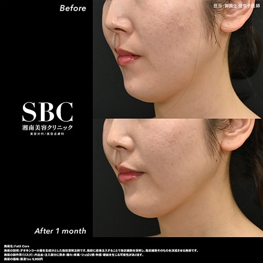 FatXcore（脂肪溶解注射）の腫れと効果