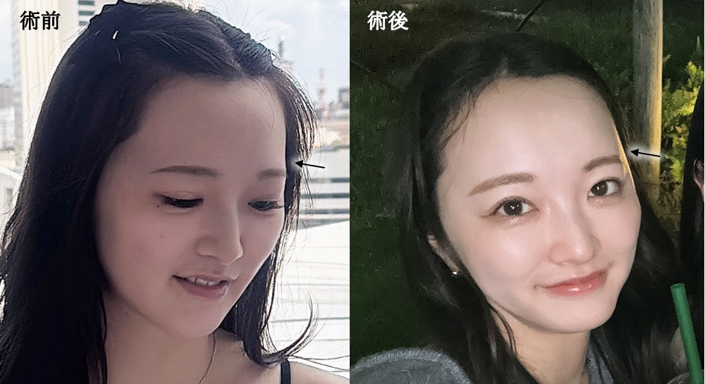 【おでこ・こめかみ】ふっくら丸みで可愛らしく