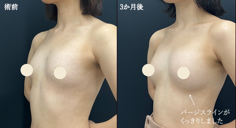 【脂肪豊胸】自然なボリュームと柔らかさ