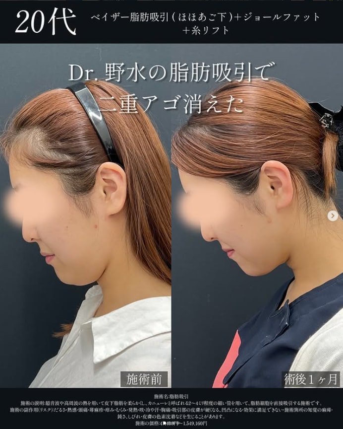 顔の脂肪吸引のダウンタイムと劇的変化