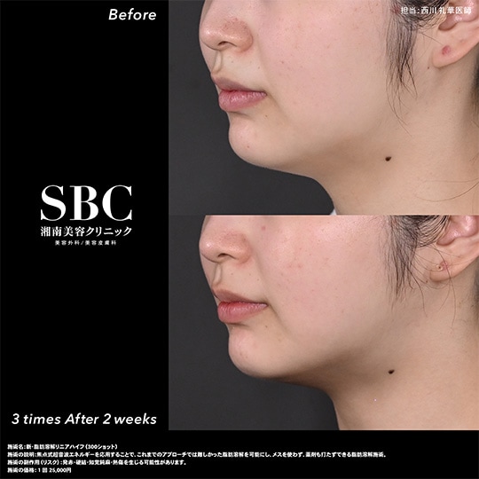 リニアHIFU（ハイフ）のダウンタイムと効果