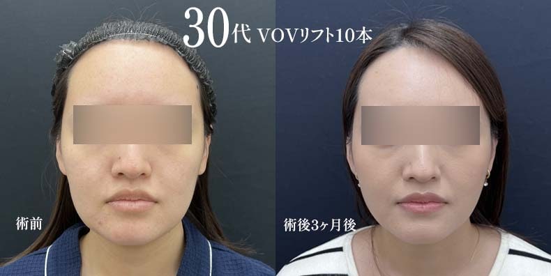 【糸リフト】目黒 自由が丘で選ばれる湘南美容クリニックで症例数34万件以上のスレッドリフト - 自由が丘院
