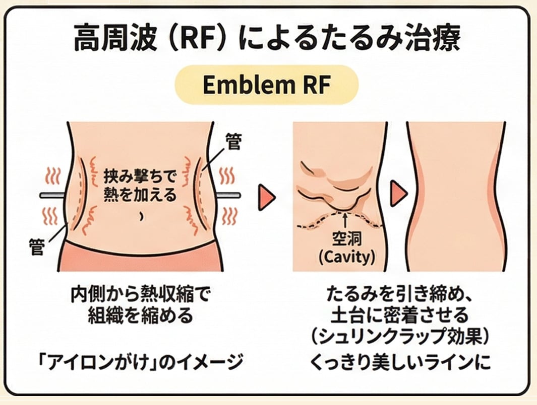  脂肪吸引の最強のパートナー「エンブレイスRF」