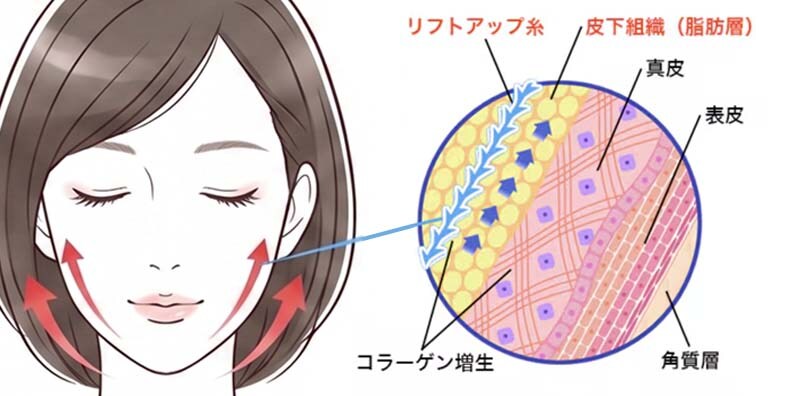 自由が丘院が提供する糸リフト(スレッドリフト)の定義と特徴