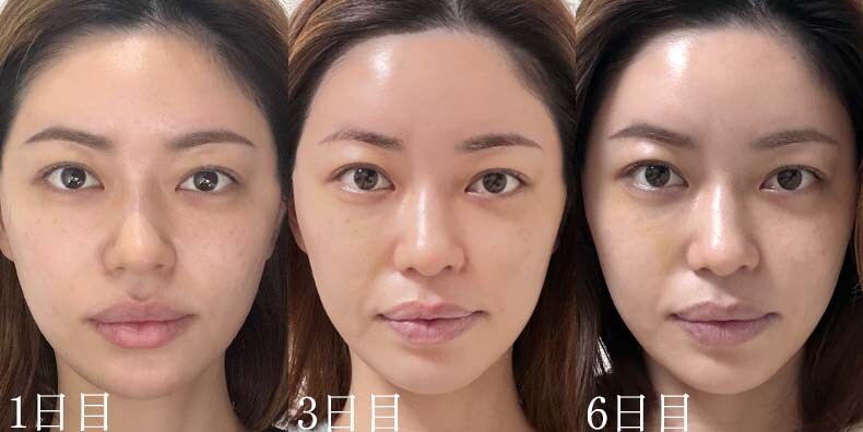 術後の腫れ・内出血の経過と過ごし方