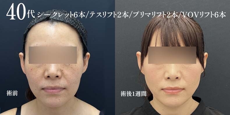 【糸リフト】40代女性/1週間後の症例