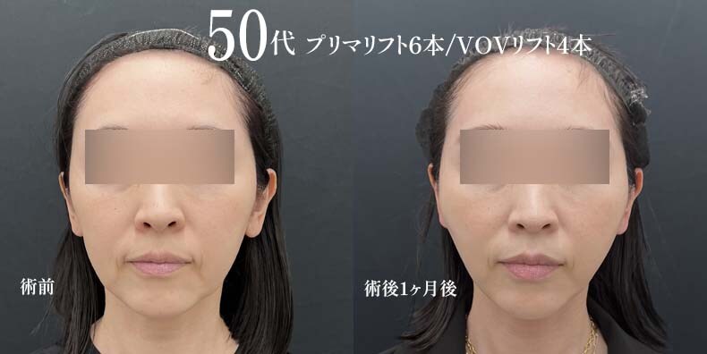 【糸リフト】50代女性/1ヶ月後の症例