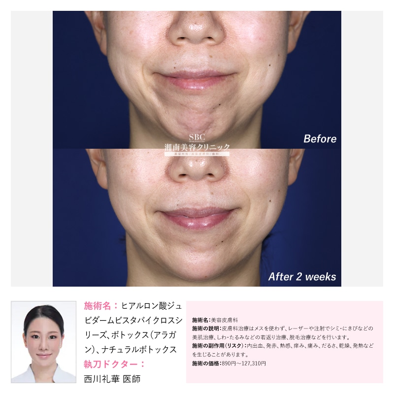 ボトックスで『梅干しジワ』と『垂れた口角』を改善<br />
