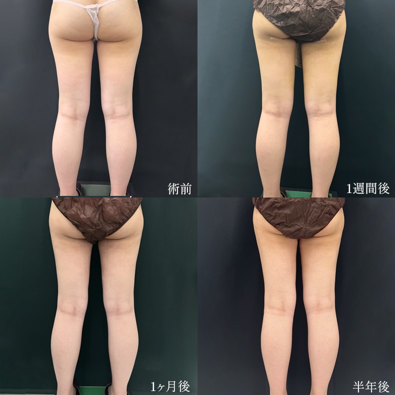 VASER脂肪吸引(臀部＋太もも＋膝)