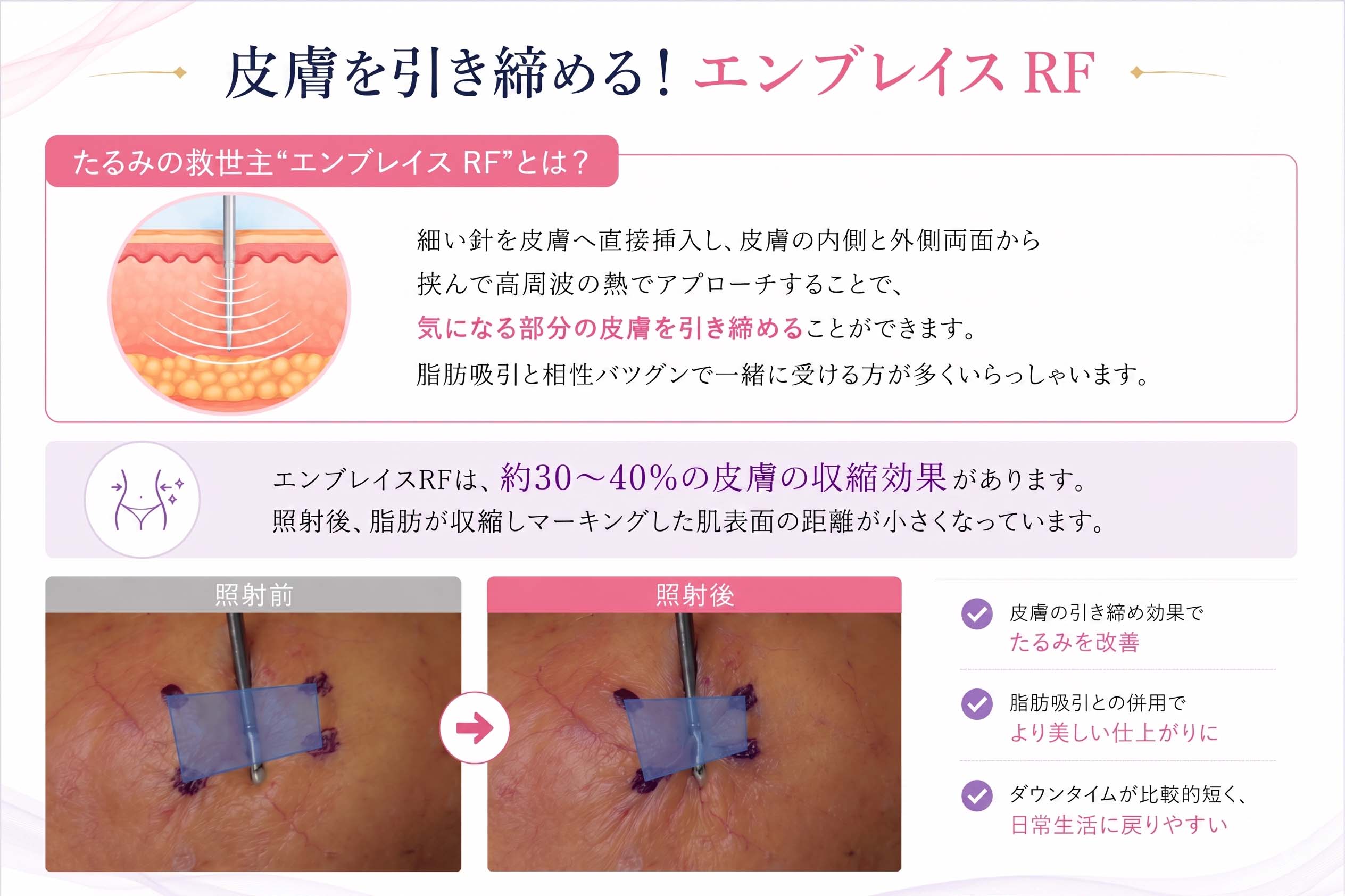 エンブレイスは必要？