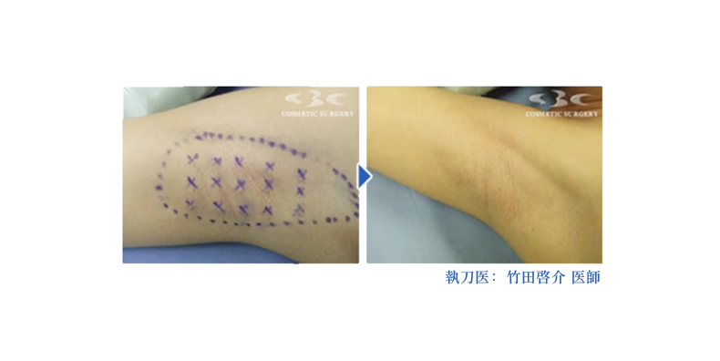 汗じみを気にしない快適な生活