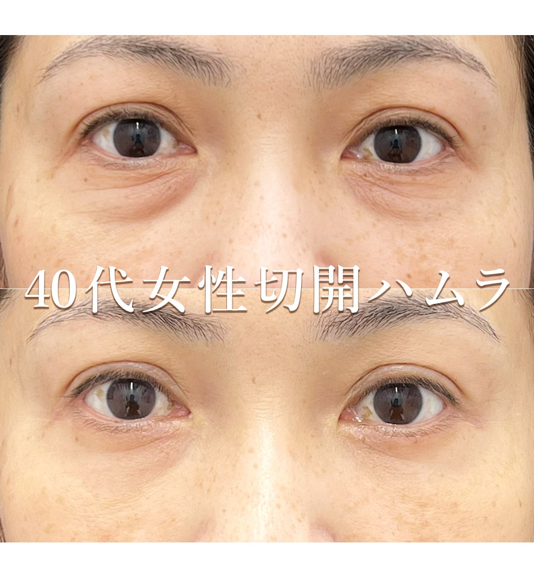 切開ハムラ症例