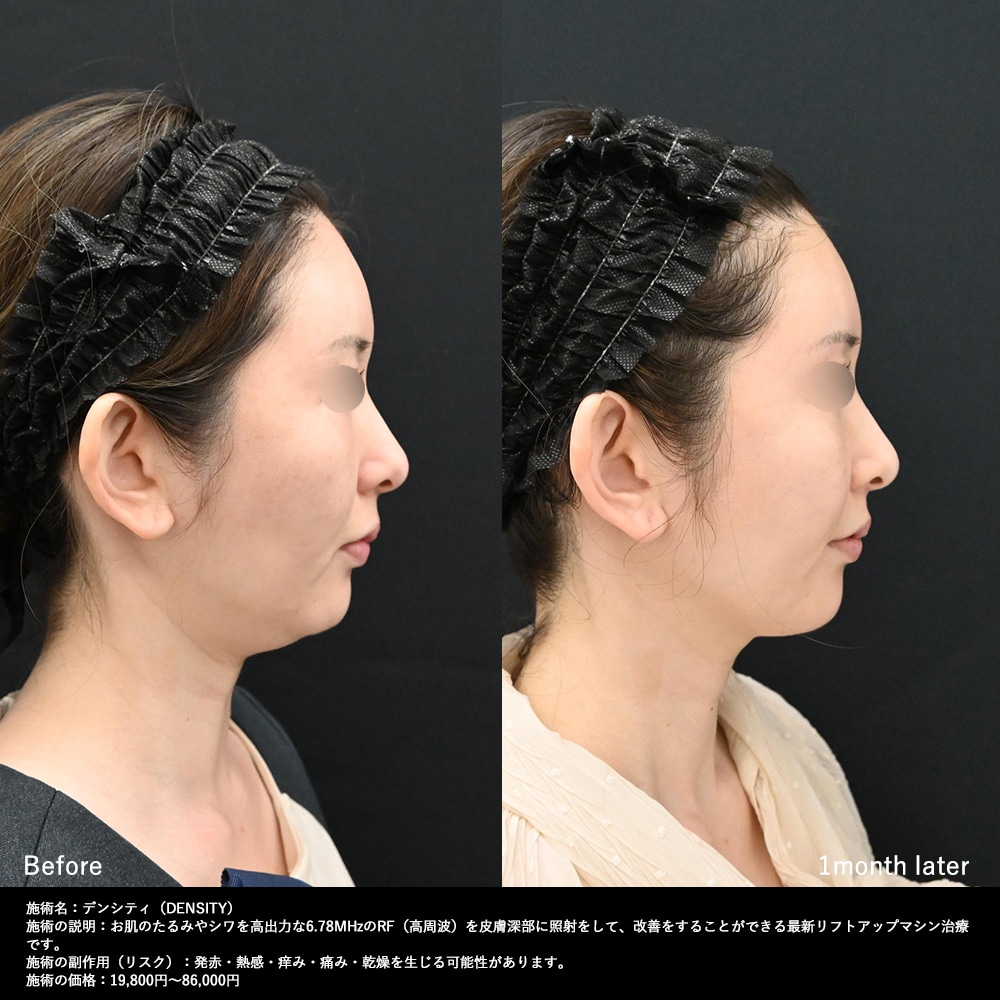デンシティのたるみ・輪郭のもたつき1か月後症例