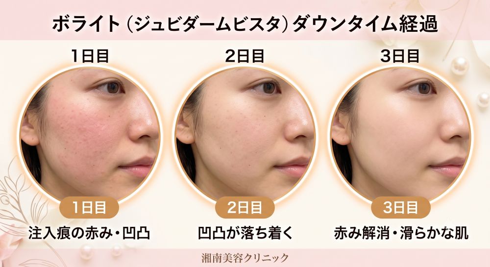 注射後の腫れや内出血はいつから引く？期間の目安<br />

