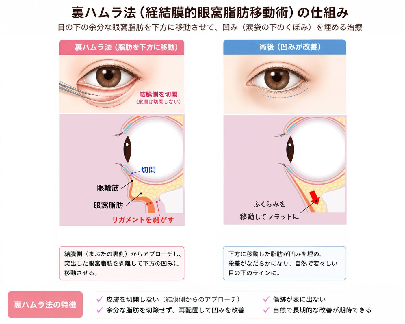 裏ハムラ法（経結膜的眼窩脂肪移動術）の仕組み