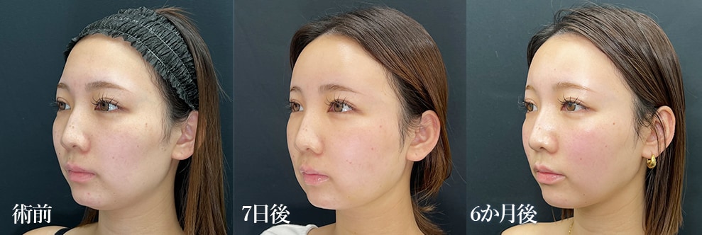 腫れ・内出血の期間（ダウンタイム）