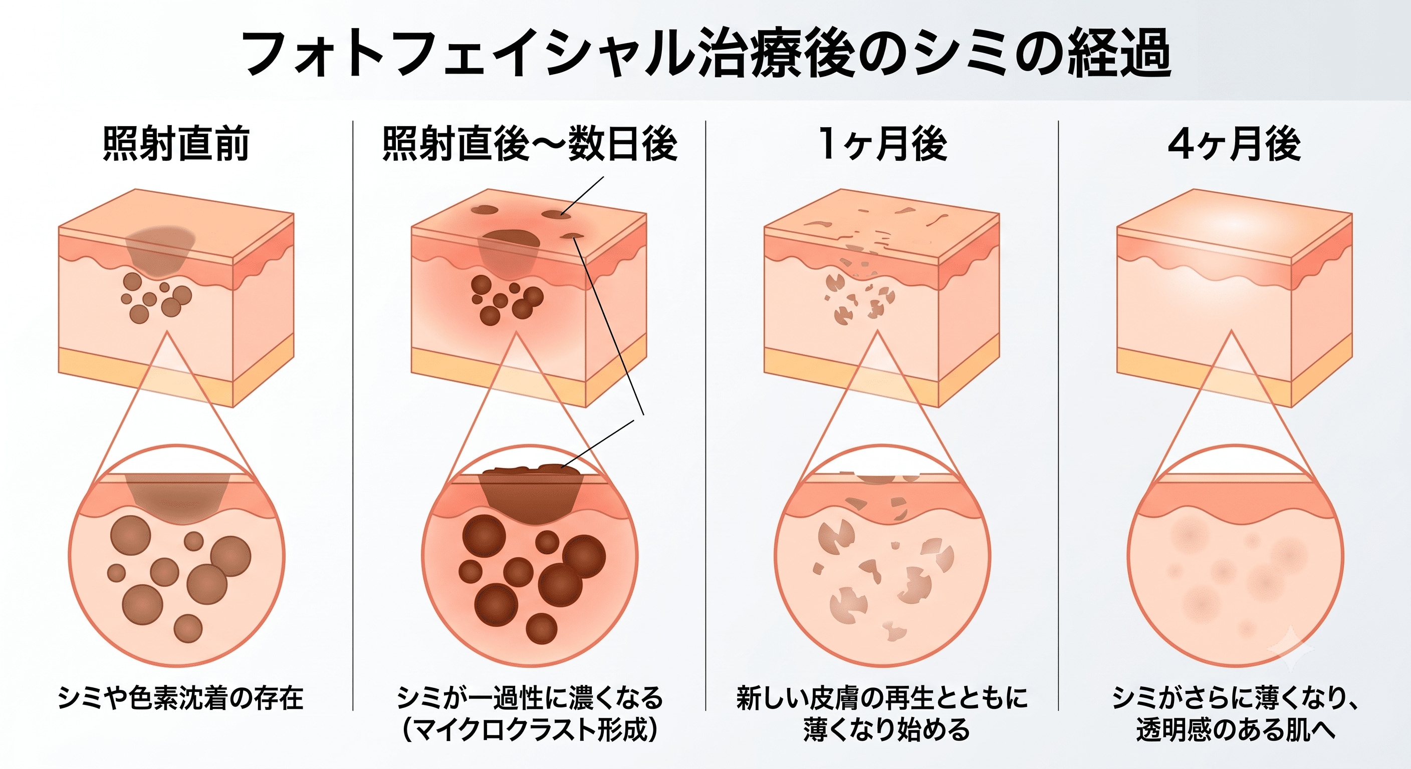 シミが濃くなる「黒浮き」と「かさぶた」