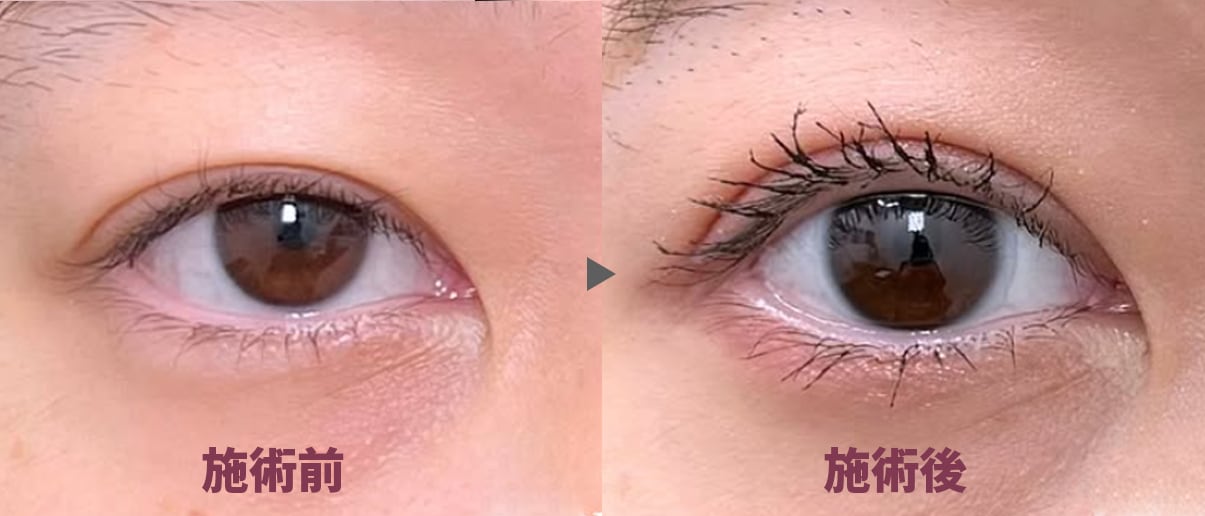 切らない眼瞼下垂 症例