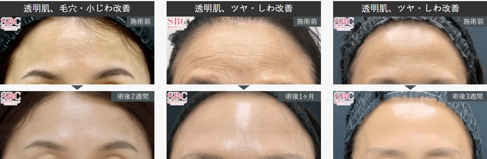 女優注射 症例