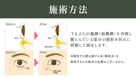 ✧ 裏ハムラ法 脂肪を取りたくない方・若くて症状が軽い方向け<br />
