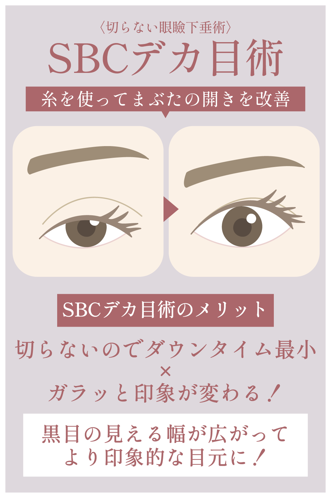 SBCデカ目術