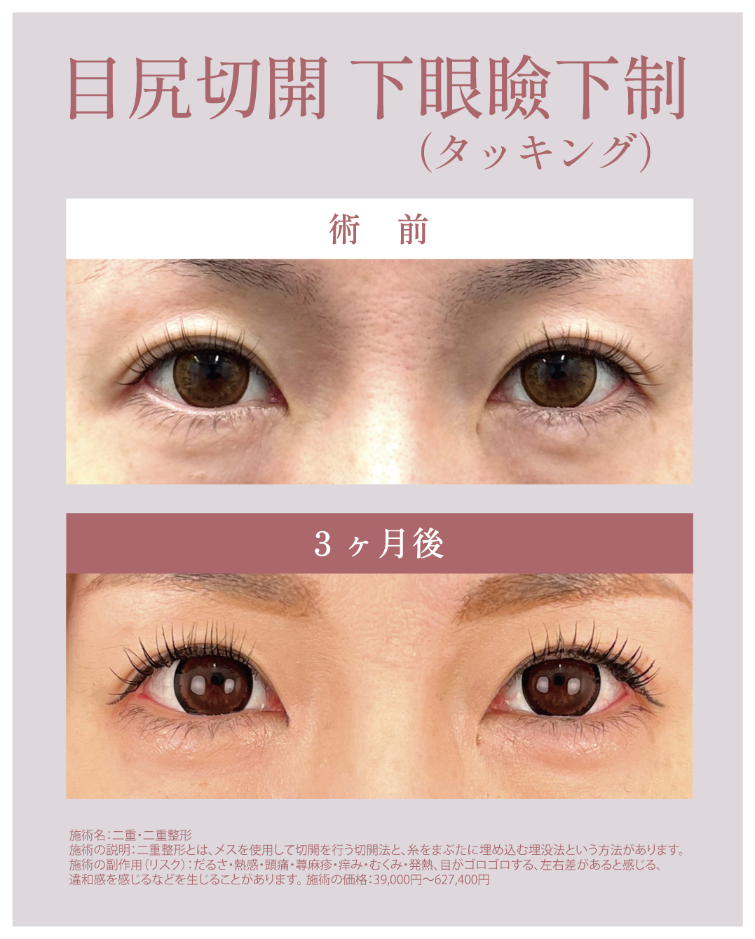 目尻切開＋下眼瞼下制