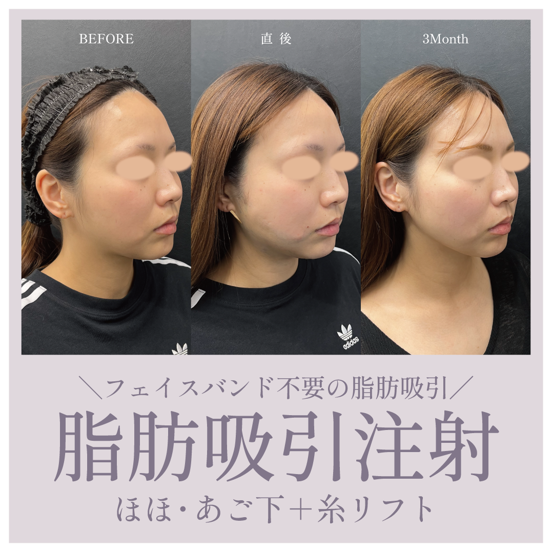 フェイスバンド不要の脂肪吸引!