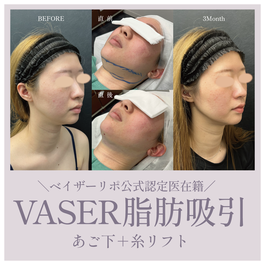 ベイザーリポ認定医在籍!
