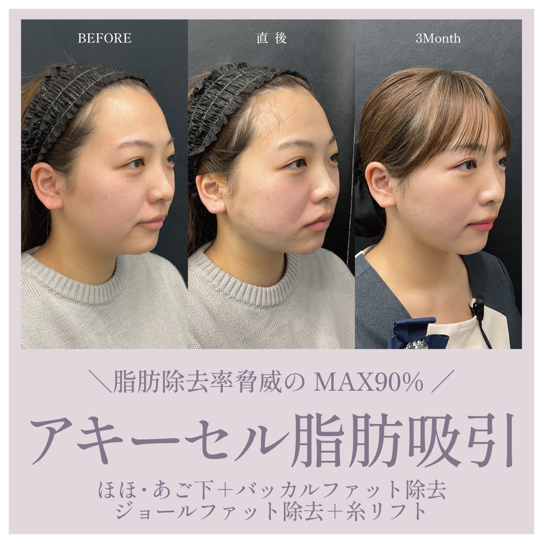 脅威の脂肪除去率90%+低ダウンタイム!