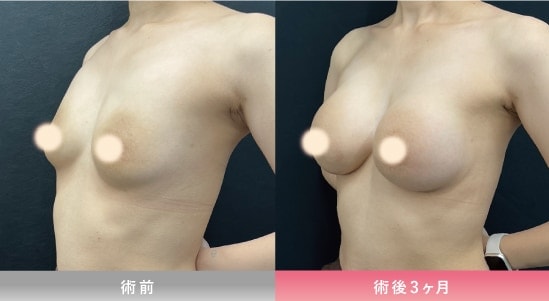 シリコンバッグでボリュームアップ!